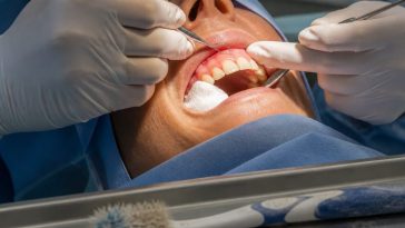 Kelly Ripa Admits Brushing Too Much Caused Gum Surgery